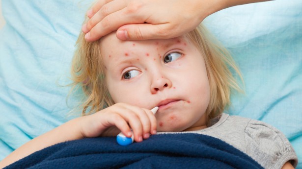 Measles – make sure  you vaccinate